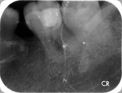 Dent vivante 1 estxzw - Eugenol