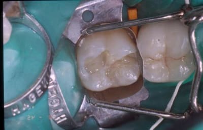 Dentine eyywvf - Eugenol