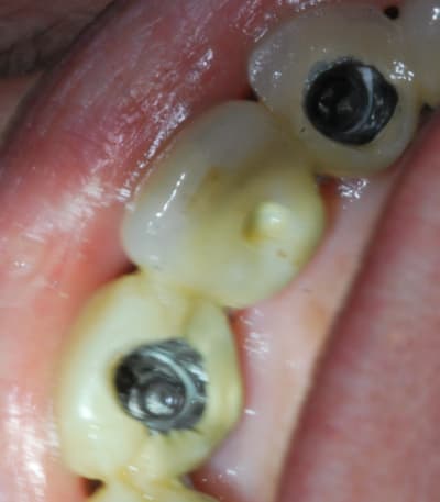 Depose bridge sur implants 3 mypsuw - Eugenol