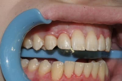 Droite2 tb1t2h - Eugenol