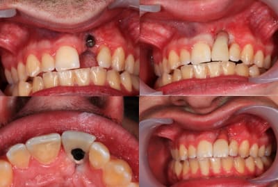 Dynamic abutment okf8ld - Eugenol