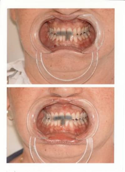 Eclaircissement ou dentosophie 2 dqidqu - Eugenol