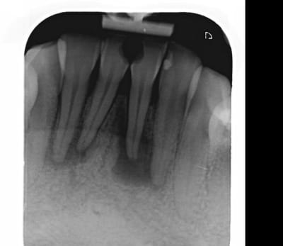 Endo2 hoj7ns - Eugenol