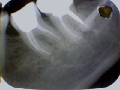 Endo2 tao4a6 - Eugenol