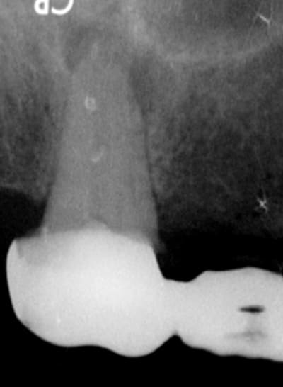 Endo 12  1  preop j7svi4 - Eugenol