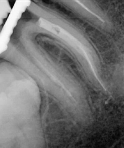 Endo 4  3  lime cass e racine obtur e xfgnty - Eugenol