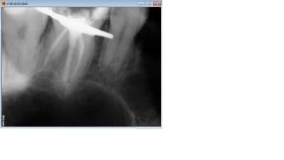 Endo 4 semoks - Eugenol