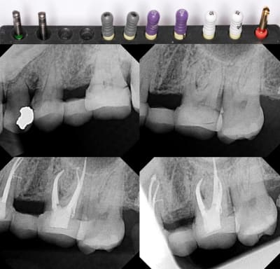 Endo  f2  ghuutc - Eugenol