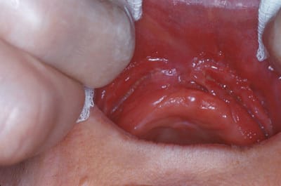 Epulis fissurant v6vwbr - Eugenol