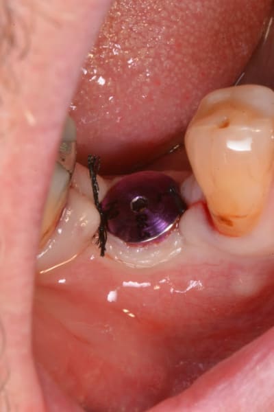 Evaseur 2 pnkmof - Eugenol