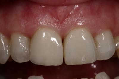 Facette  5  idmvdi - Eugenol