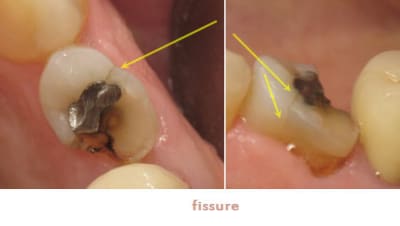 Fissure oe5acn - Eugenol