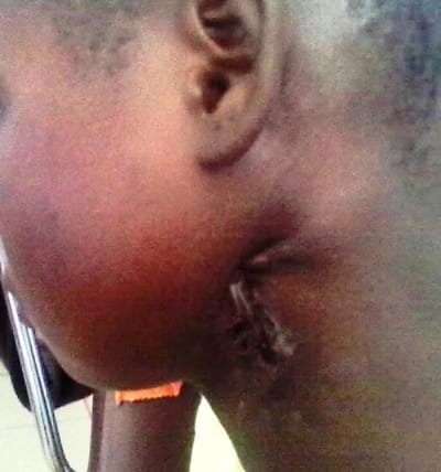 Fistulisation dans le cou gyxwvz - Eugenol