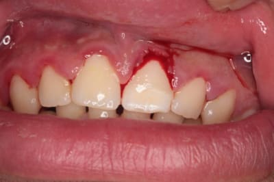 Fracture 21  3   800x600  koupc5 - Eugenol