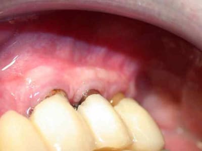 Gencive attachée wpl2bk - Eugenol