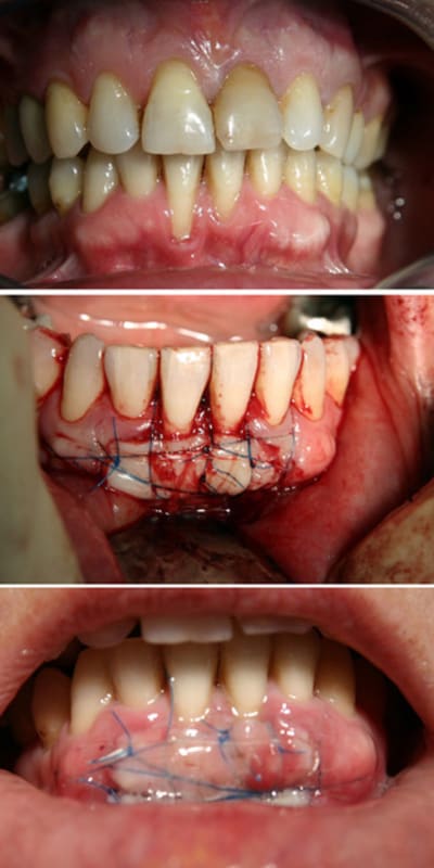 Greffe av ap r3irdu - Eugenol