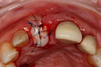 Greffe gingivale tkjs9v - Eugenol