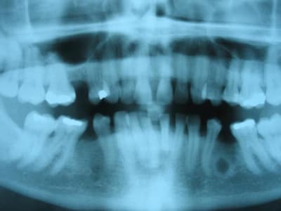 Image osseuse njs25r - Eugenol