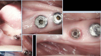 Images implants k gclxis - Eugenol