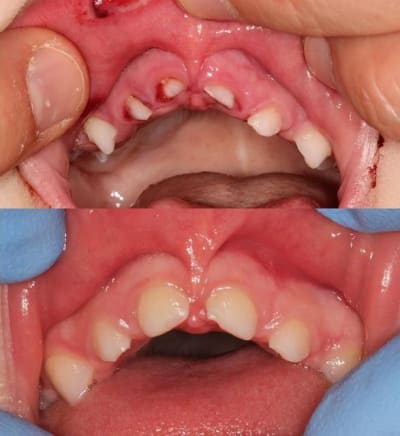 Impac   copie - Eugenol