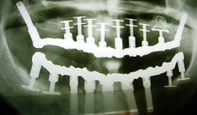 Implant x ray lf2i6f - Eugenol