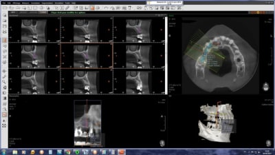 Implant2 mlwcqt - Eugenol