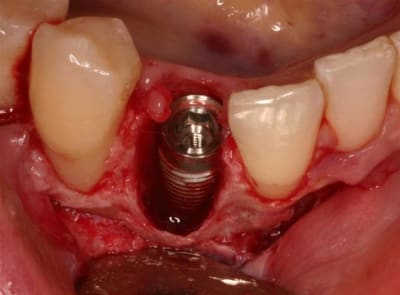 Implant 43 imm - Eugenol