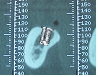 Implant 8x5 tdigml - Eugenol