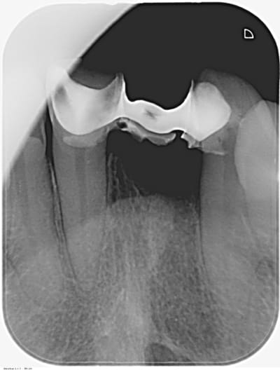 Implant ant fqovrw - Eugenol