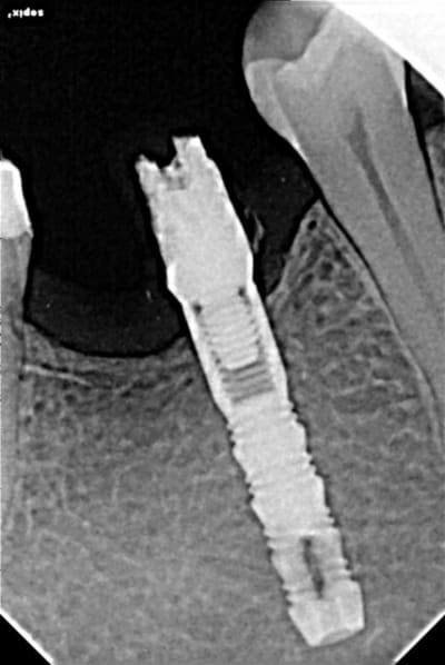 Implant aucpum - Eugenol