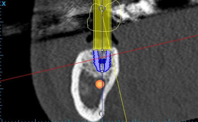 Implant centr     46  zzdyn7 - Eugenol