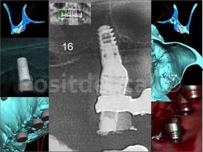 Implant en 16 rd70gl - Eugenol