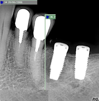 Implant image pas nette l4frwl - Eugenol