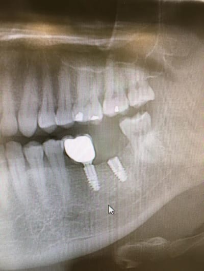 Implant joep0q - Eugenol