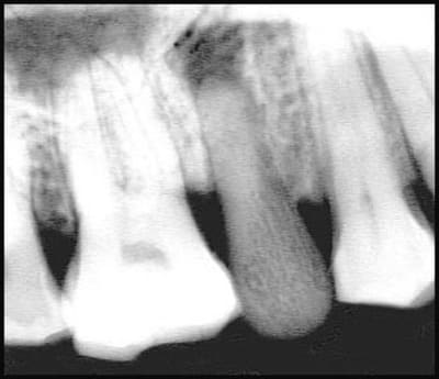 Implant otxecs - Eugenol