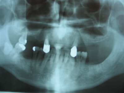 Implant possible rhojd0 - Eugenol