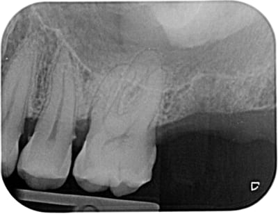 Implant pradaxa z75zvf - Eugenol