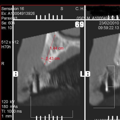 Implant ywxv02 - Eugenol