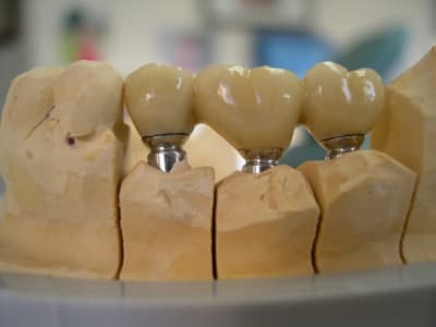 Implants 001 lfucq1 - Eugenol