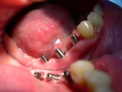 Implants 007 sfc4eg - Eugenol