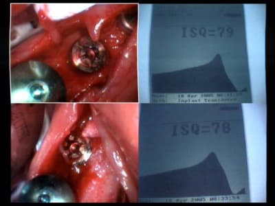 Implants 46 et 47  isq    oz7wye - Eugenol