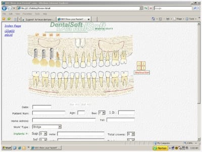 Implants crowns my7z3i - Eugenol