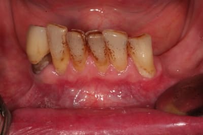 Initial mandibule u5akcq - Eugenol