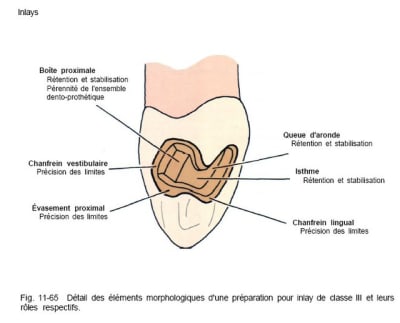 Inlay 3 liqjxi - Eugenol