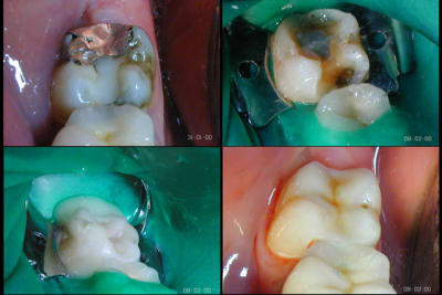 Inlay 8 fev 00  riwabk - Eugenol