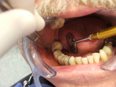 Inlay  contre inlay la850t - Eugenol