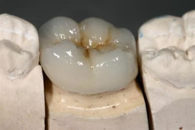 Joint ceram  1  llgted - Eugenol