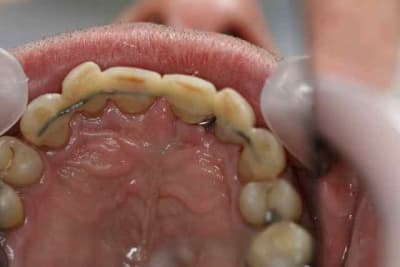 Jonc splint fizngd - Eugenol