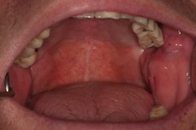 Joue ibdddt - Eugenol