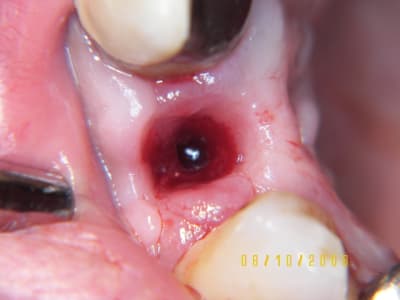 Kavitaet mrphru - Eugenol